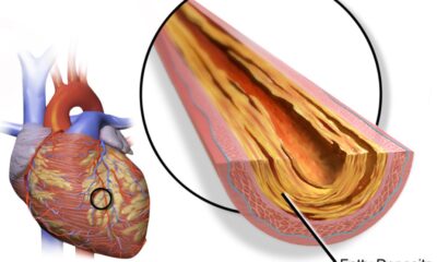 15 Synonyms for Heart Attack: Expand Your Medical Vocabulary